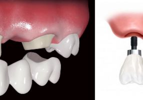Prótese Dentária